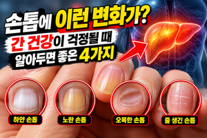 "손톱만 보고 알 수 있을까?" 간 건강이 걱정될 때 확인해야 할 변화 4가지 썸네일